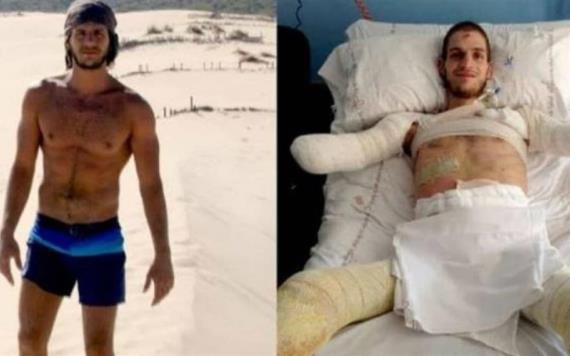Tras diagnóstico erróneo, joven pierde las extremidades en España