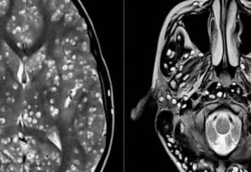 Padecía fuertes dolores de cabeza; ¡su cerebro estaba lleno de larvas!