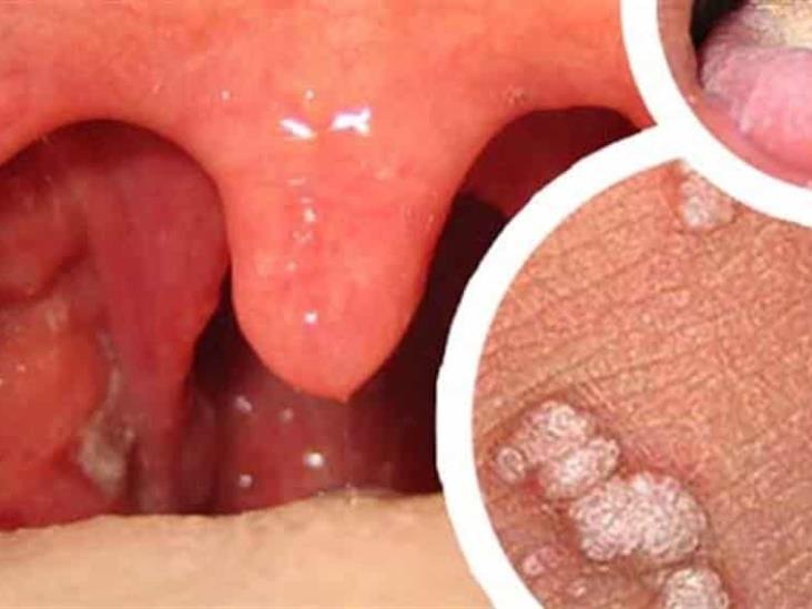 Papiloma humano en boca tratamiento