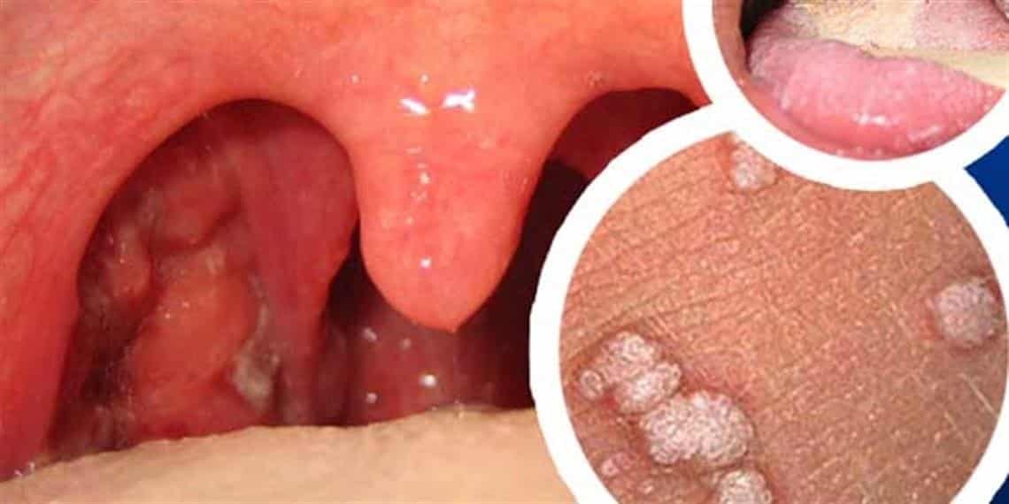 virus papiloma en la boca imagenes