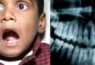 Video: Extraen más de 500 dientes a un niño