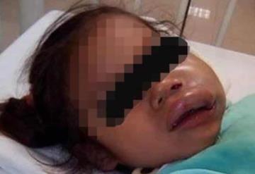 Entregan en kínder a niña con labio hinchado y moretones; ‘está bien’