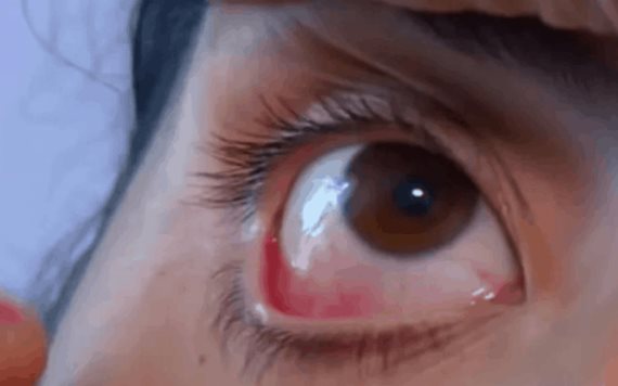 Video: Mujer llora cristales, los médicos desconocen la razón