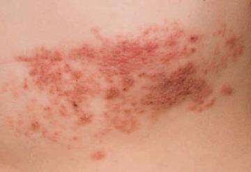 ¿Sufres de estrés? Alerta, podrías detonar herpes zóster