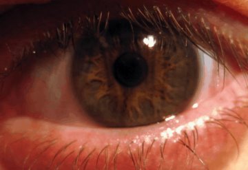 ¿Tienes conjuntivitis? Podría ser un síntoma de covid