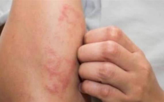 Se han detectado 74 casos de lepra en el País