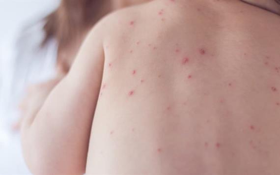 Han detectado 20 casos de varicela en lo que va del año