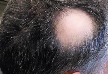 Alopecia, secuela a largo plazo del Covid-19, afirman expertos de la UNAM