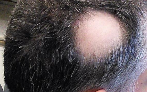 Alopecia, secuela a largo plazo del Covid-19, afirman expertos de la UNAM