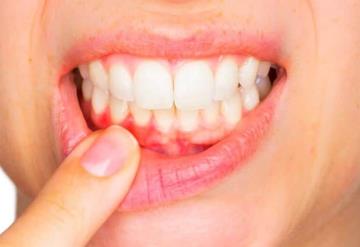 ¿Sabes que causa la gingivitis?