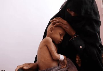 En Yemen, millones de niños en riesgo de morir por desnutrición aguda