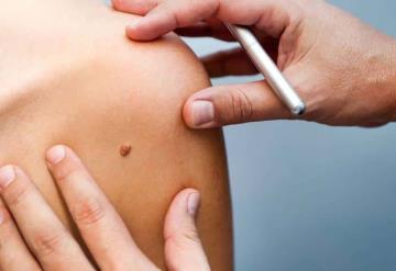 Día Mundial del Melanoma: por qué es importante checar los lunares