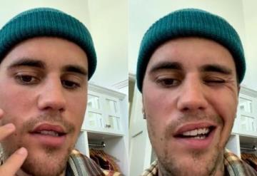 Justin Bieber revela que tiene la mitad de la cara paralizada: No me puedo reír