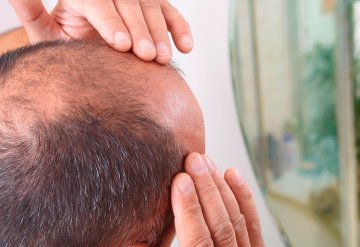 FDA aprueba primer tratamiento contra alopecia