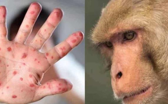 Confirman dos casos de viruela del mono en EDOMEX