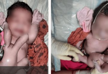 Bebé nace con 4 piernas y 4 brazos en India