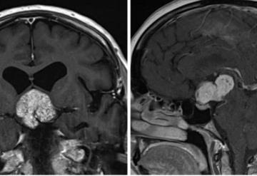 En casos raros, la viruela del simio puede provocar una peligrosa inflamación en el cerebro