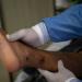 Confirman 321 nuevos casos de viruela símica en una semana en México