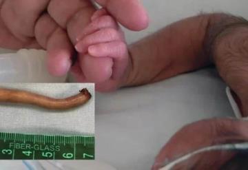 Bebé nace con cola de 6 cm al Norte de México y causa revuelo en Internet