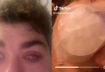 Joven toma una siesta con sus lentes de contacto y queda ciego de un ojo